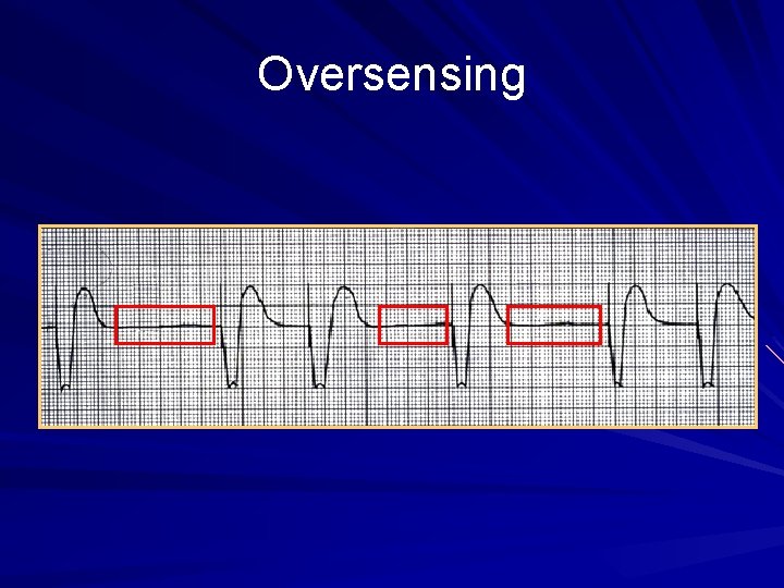 Oversensing 