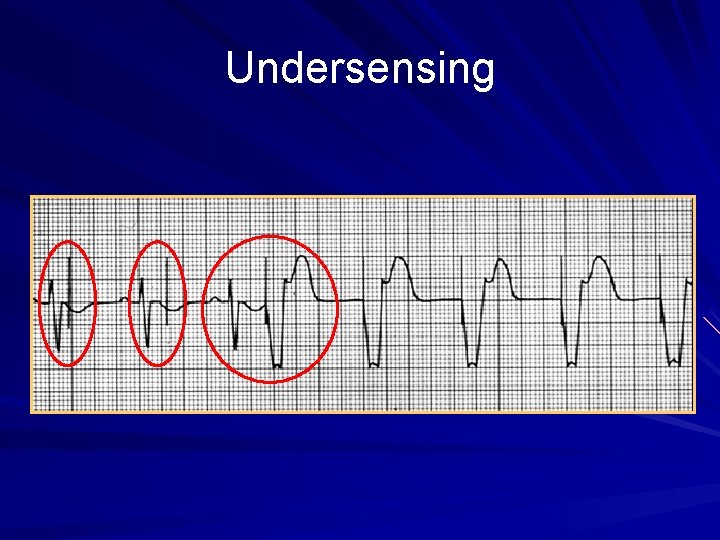 Undersensing 