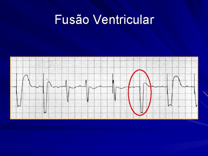 Fusão Ventricular 