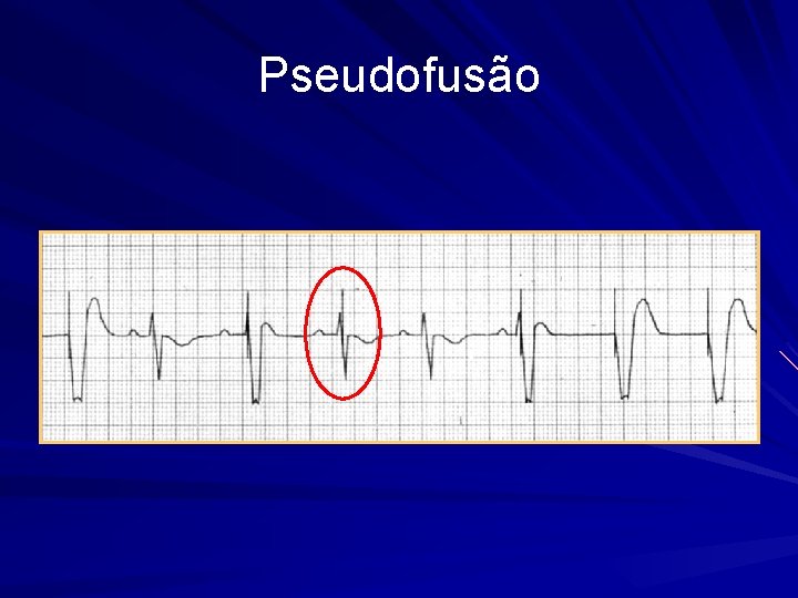 Pseudofusão 