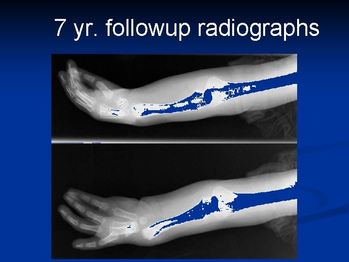 7 yr. followup radiographs 