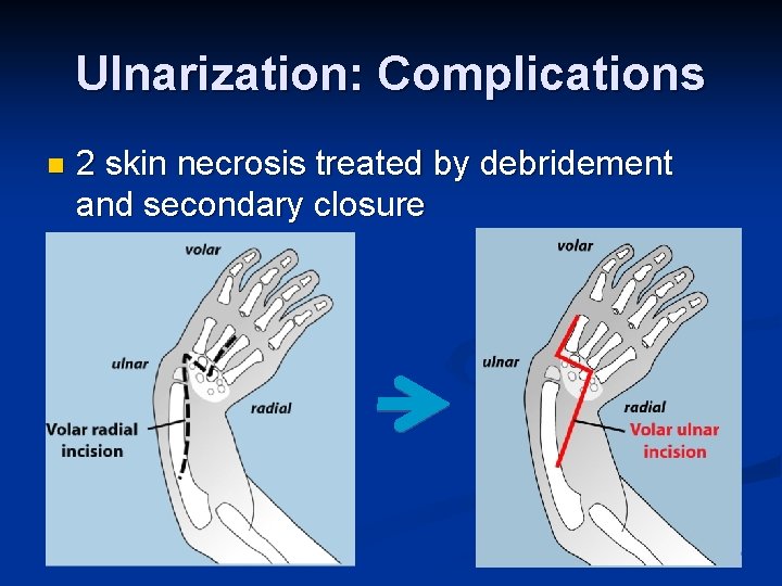 Ulnarization: Complications n 2 skin necrosis treated by debridement and secondary closure 