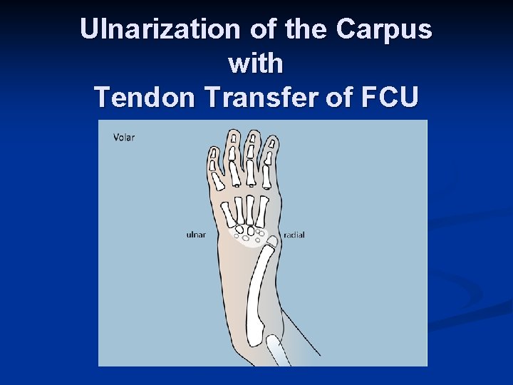 Ulnarization of the Carpus with Tendon Transfer of FCU 
