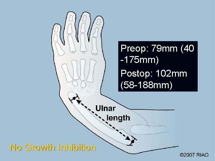 Preop: 79 mm (40 -175 mm) Postop: 102 mm (58 -188 mm) No Growth