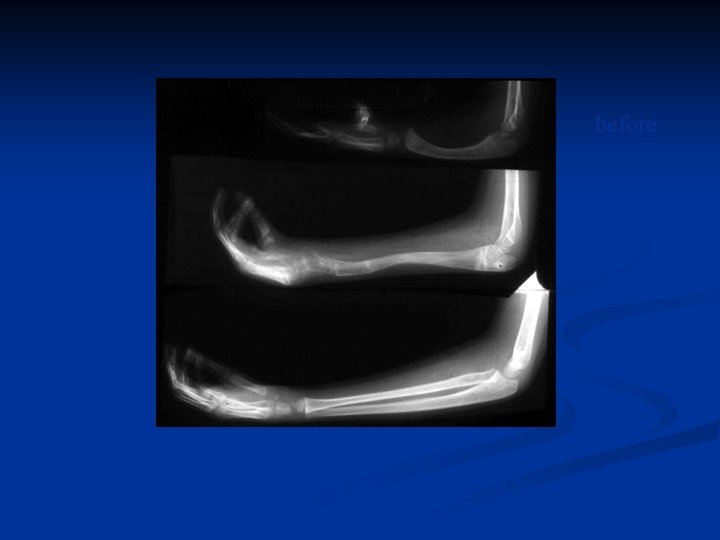 before after normal Before vs After 1 st Lengthening vs Normal side 