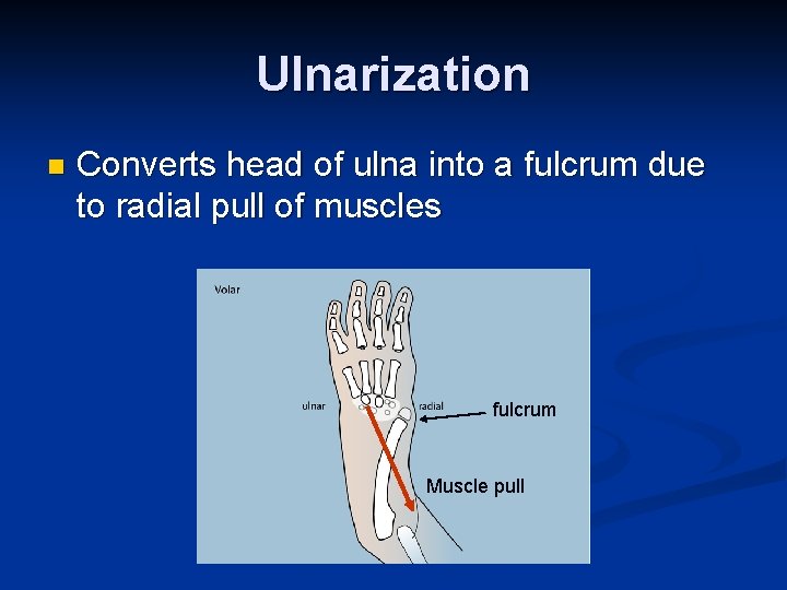 Ulnarization n Converts head of ulna into a fulcrum due to radial pull of