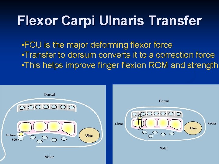 Flexor Carpi Ulnaris Transfer • FCU is the major deforming flexor force • Transfer