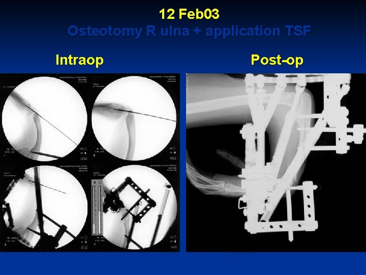 12 Feb 03 Osteotomy R ulna + application TSF Intraop Post-op 