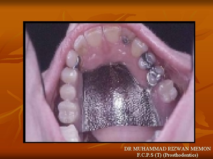 DR MUHAMMAD RIZWAN MEMON F. C. P. S (T) (Prosthodontics) 