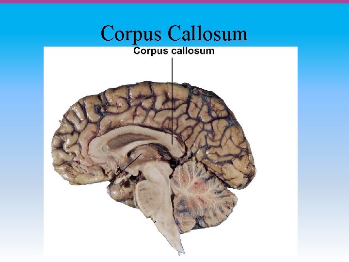 Corpus Callosum 