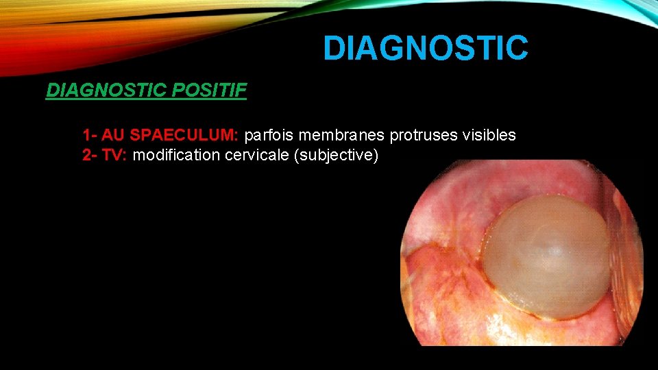 DIAGNOSTIC POSITIF 1 - AU SPAECULUM: parfois membranes protruses visibles 2 - TV: modification