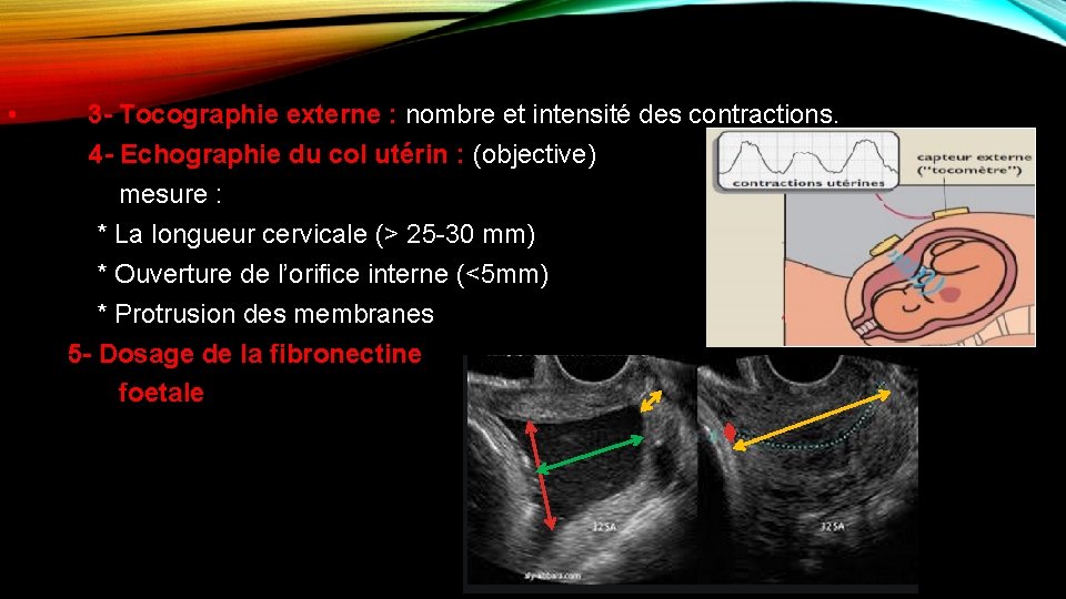  • 3 - Tocographie externe : nombre et intensité des contractions. 4 -