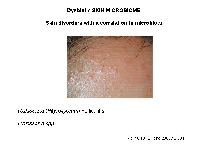 Dysbiotic SKIN MICROBIOME Skin disorders with a correlation to microbiota Malassezia (Pityrosporum) Folliculitis Malassezia