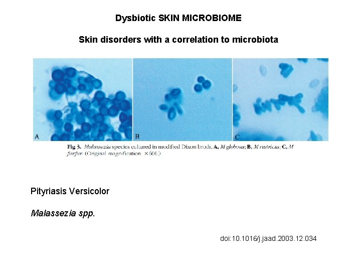 Dysbiotic SKIN MICROBIOME Skin disorders with a correlation to microbiota Pityriasis Versicolor Malassezia spp.