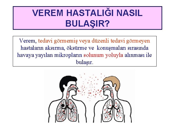 VEREM HASTALIĞI NASIL BULAŞIR? Verem, tedavi görmemiş veya düzenli tedavi görmeyen hastaların aksırma, öksürme