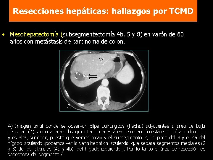 Resecciones hepáticas: hallazgos por TCMD • Mesohepatectomía (subsegmentectomía 4 b, 5 y 8) en