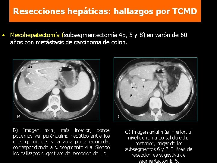 Resecciones hepáticas: hallazgos por TCMD • Mesohepatectomía (subsegmentectomía 4 b, 5 y 8) en