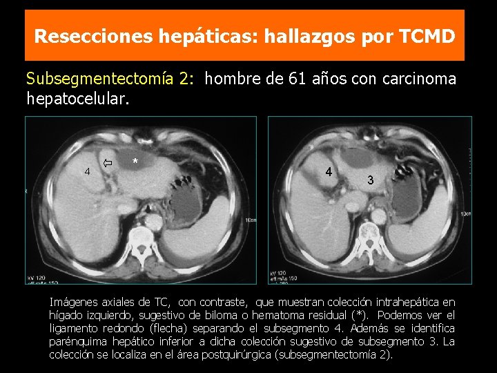 Resecciones hepáticas: hallazgos por TCMD Subsegmentectomía 2: hombre de 61 años con carcinoma hepatocelular.
