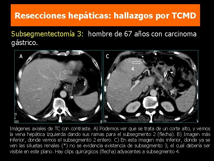 Resecciones hepáticas: hallazgos por TCMD Subsegmentectomía 3: hombre de 67 años con carcinoma gástrico.