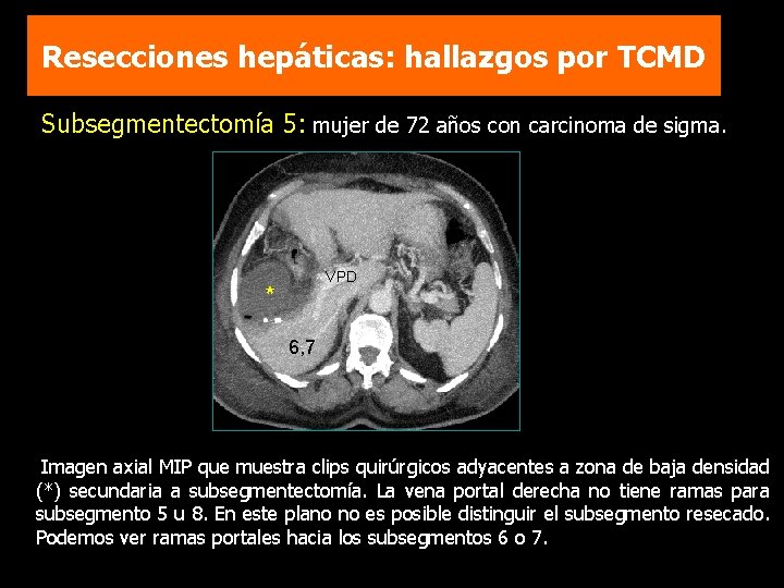 Resecciones hepáticas: hallazgos por TCMD Subsegmentectomía 5: mujer de 72 años con carcinoma de