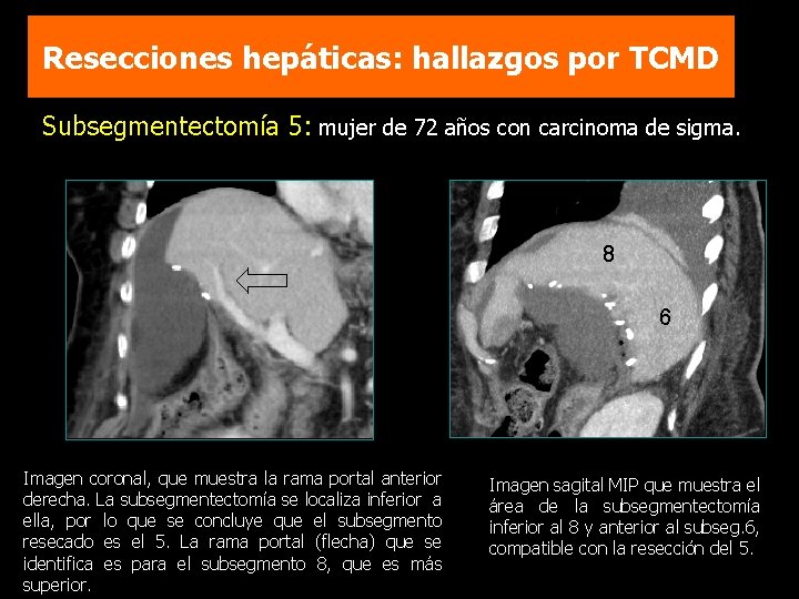 Resecciones hepáticas: hallazgos por TCMD Subsegmentectomía 5: mujer de 72 años con carcinoma de