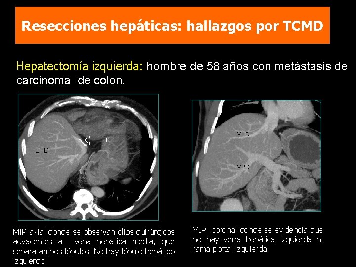 Resecciones hepáticas: hallazgos por TCMD Hepatectomía izquierda: hombre de 58 años con metástasis de