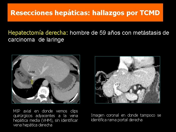 Resecciones hepáticas: hallazgos por TCMD Hepatectomía derecha: hombre de 59 años con metástasis de