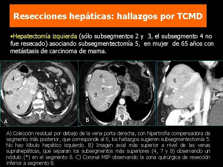 Resecciones hepáticas: hallazgos por TCMD • Hepatectomía izquierda (sólo subsegmentos 2 y 3, el
