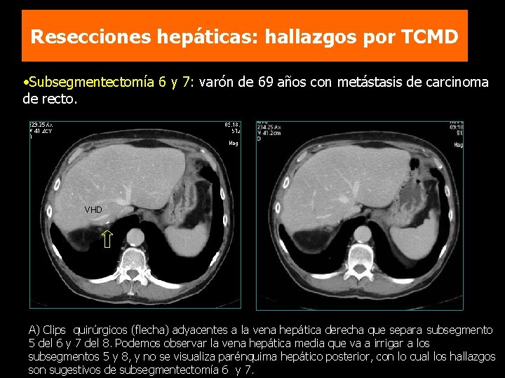 Resecciones hepáticas: hallazgos por TCMD • Subsegmentectomía 6 y 7: varón de 69 años
