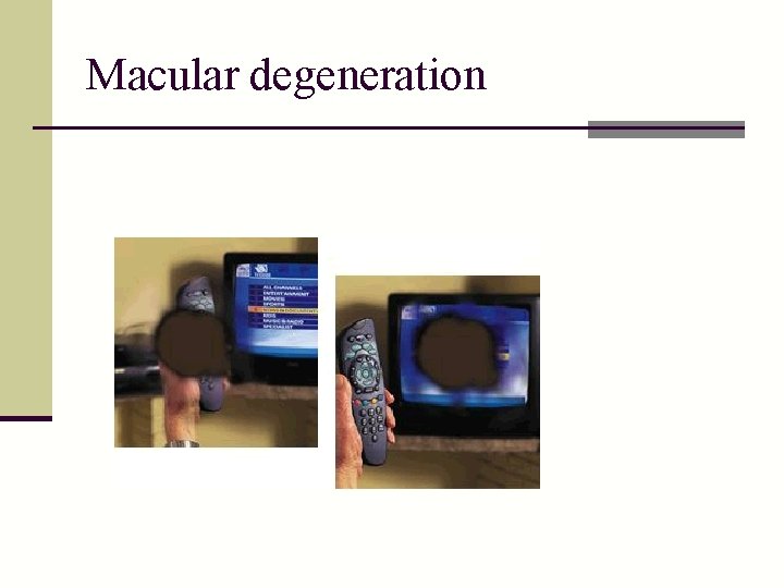 Macular degeneration 