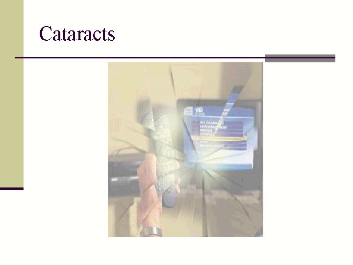 Cataracts 