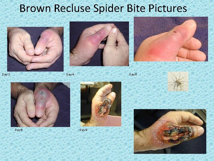 Brown Recluse Spider Bite Pictures Day 3 Day 4 Day 6 Day 5 Day