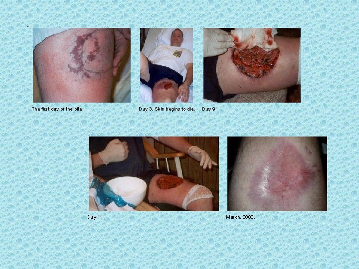 The first day of the bite. Day 3. Skin begins to die. Day 11