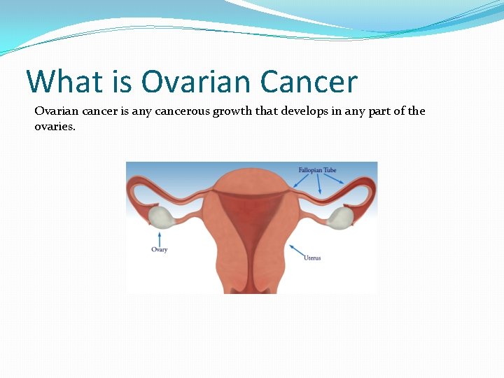 What is Ovarian Cancer Ovarian cancer is any cancerous growth that develops in any