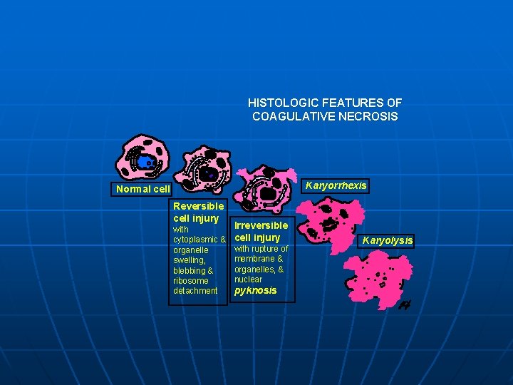 HISTOLOGIC FEATURES OF COAGULATIVE NECROSIS Karyorrhexis Normal cell Reversible cell injury with cytoplasmic &