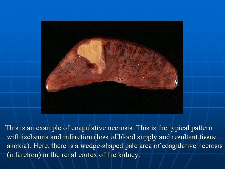 This is an example of coagulative necrosis. This is the typical pattern with ischemia