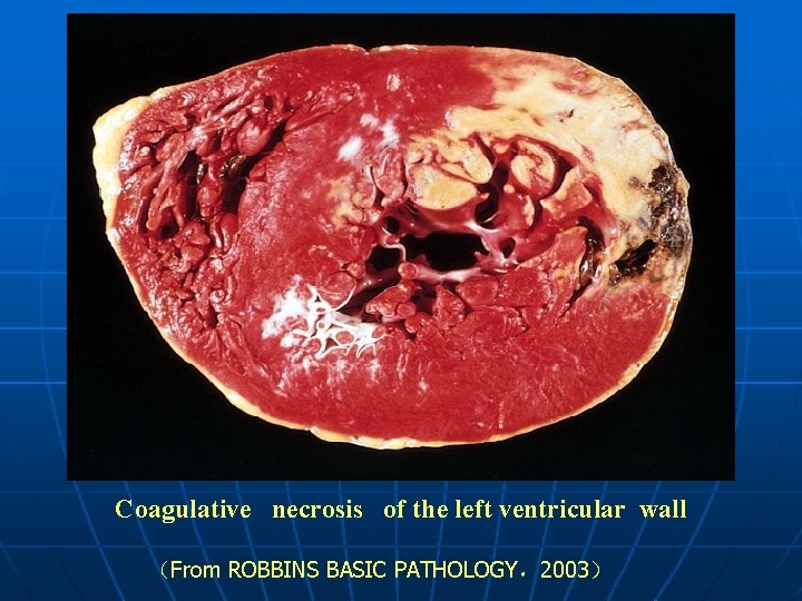 Coagulative necrosis of the left ventricular wall （From ROBBINS BASIC PATHOLOGY，2003） 