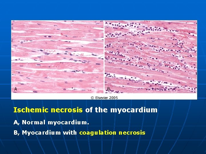 Ischemic necrosis of the myocardium A, Normal myocardium. B, Myocardium with coagulation necrosis 