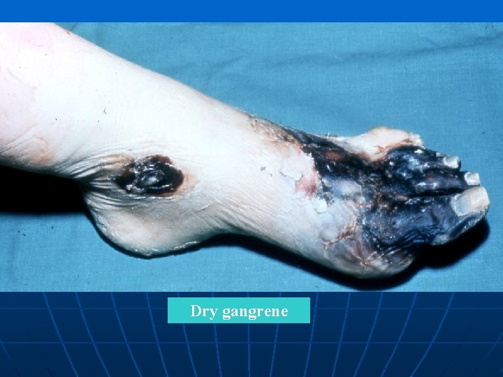 Dry gangrene 