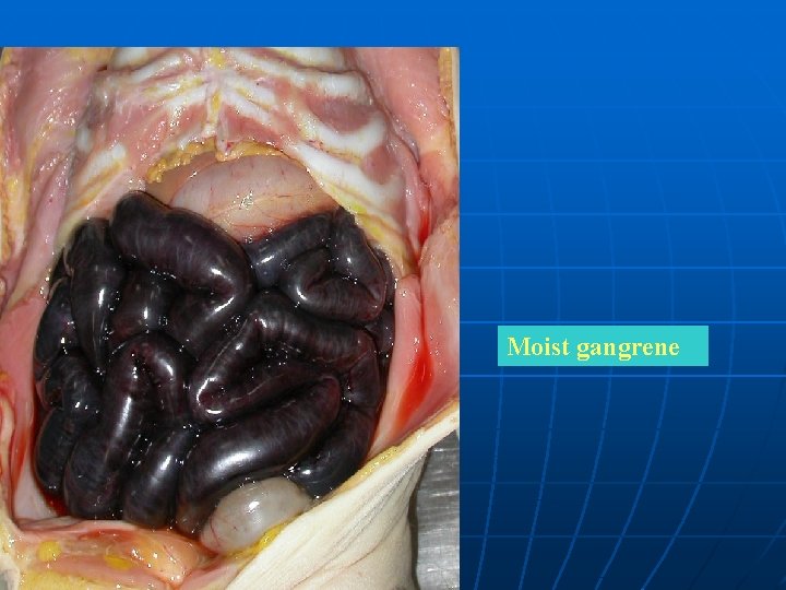 Moist gangrene 