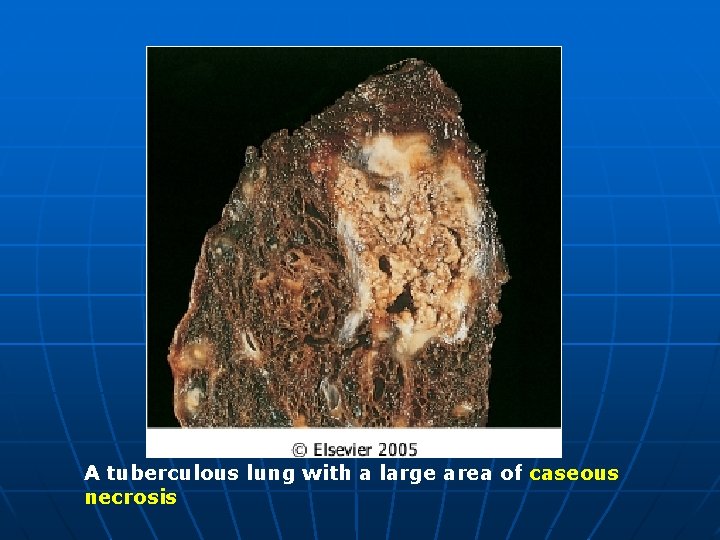 A tuberculous lung with a large area of caseous necrosis 