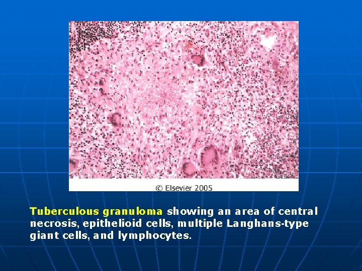 Tuberculous granuloma showing an area of central necrosis, epithelioid cells, multiple Langhans-type giant cells,