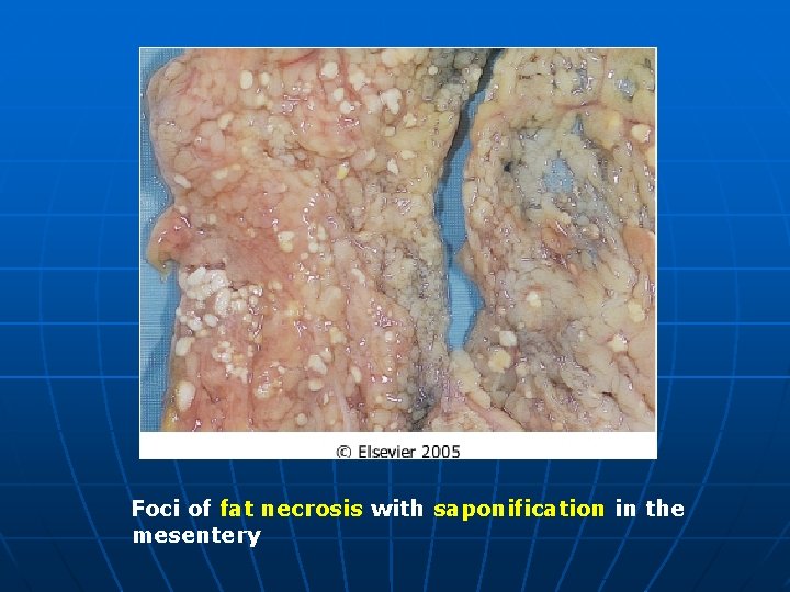 Foci of fat necrosis with saponification in the mesentery 