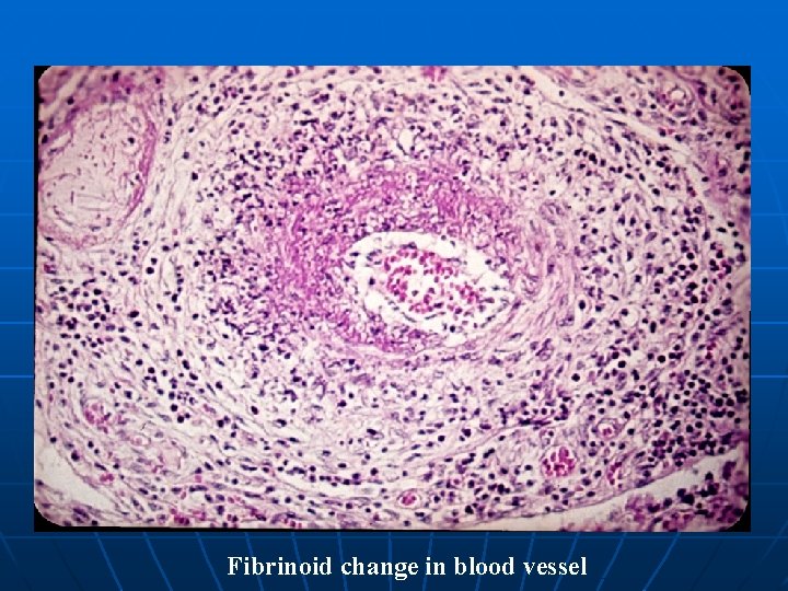 Fibrinoid change in blood vessel 