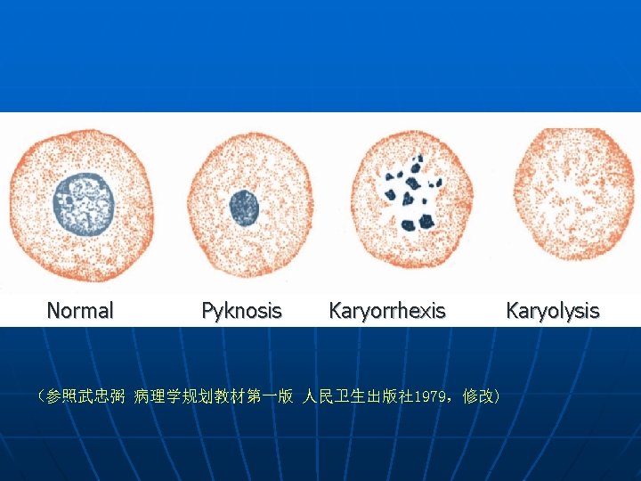 Normal Pyknosis Karyorrhexis （参照武忠弼 病理学规划教材第一版 人民卫生出版社 1979，修改) Karyolysis 