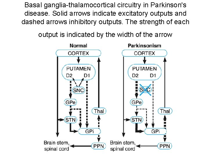 Basal ganglia-thalamocortical circuitry in Parkinson's disease. Solid arrows indicate excitatory outputs and dashed arrows
