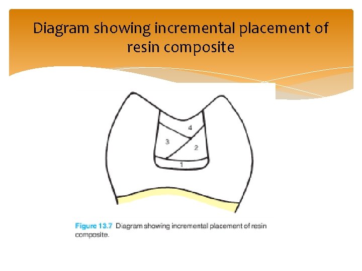 Diagram showing incremental placement of resin composite 