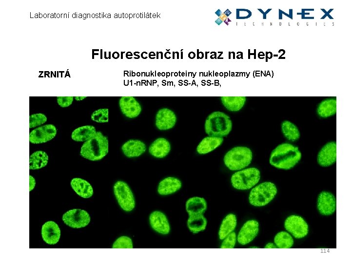 Laboratorní diagnostika autoprotilátek Fluorescenční obraz na Hep-2 ZRNITÁ Ribonukleoproteiny nukleoplazmy (ENA) U 1 -n.