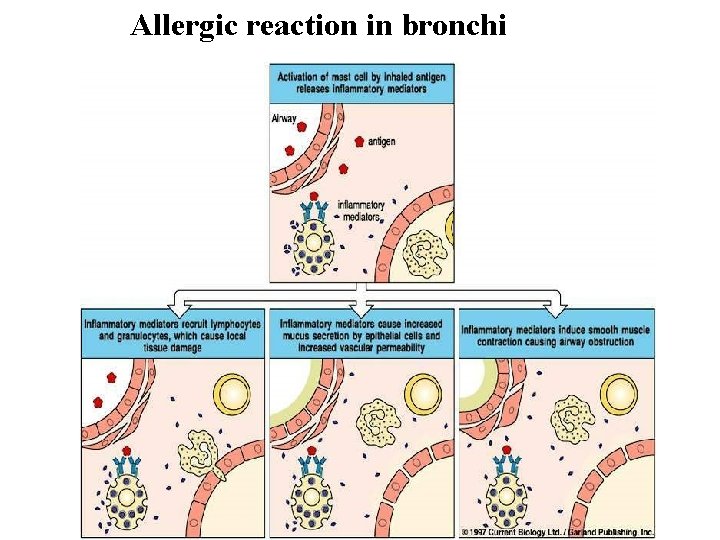 Allergic reaction in bronchi 
