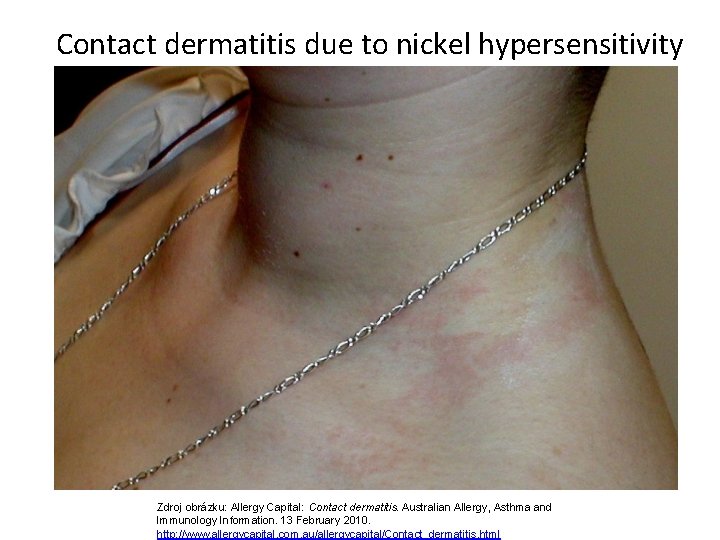 Contact dermatitis due to nickel hypersensitivity Zdroj obrázku: Allergy Capital: Contact dermatitis. Australian Allergy,